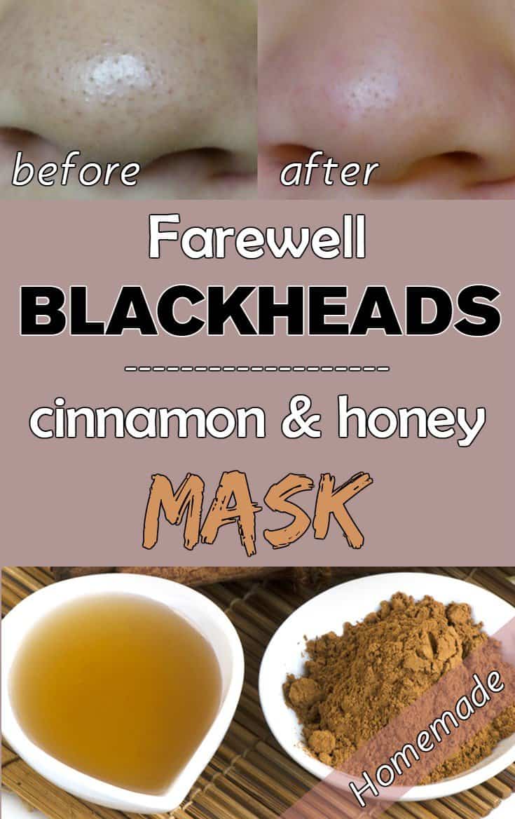 13 Safe Homemade Blackhead Remedies That Work 5995