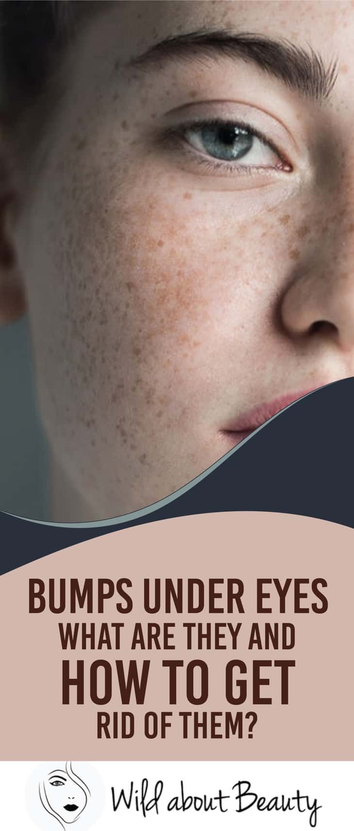 Bumps under eyes