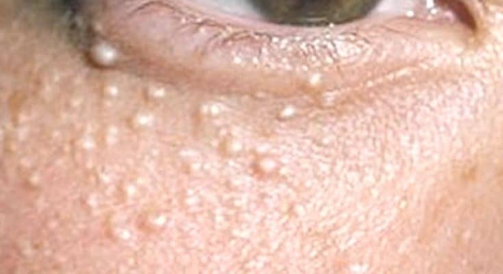 Under Eye Bumps What Are They And How To Get Rid Of Them – NBKomputer