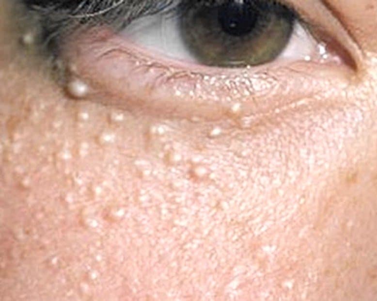 What Causes Red Bumps Under Eyes