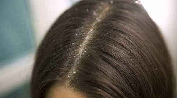 dandruff