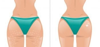 How to get rid of butt acne