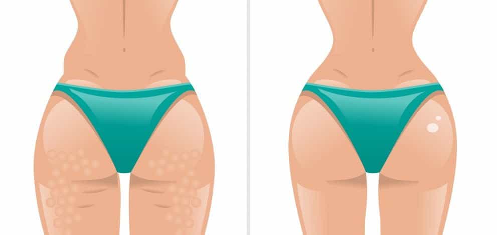 How to get rid of butt acne