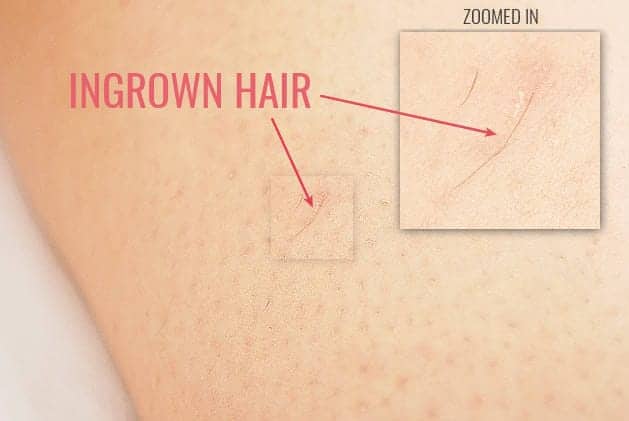 ingrown hair