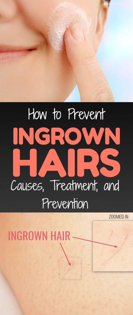 Ingrown Hair Causes And Prevention