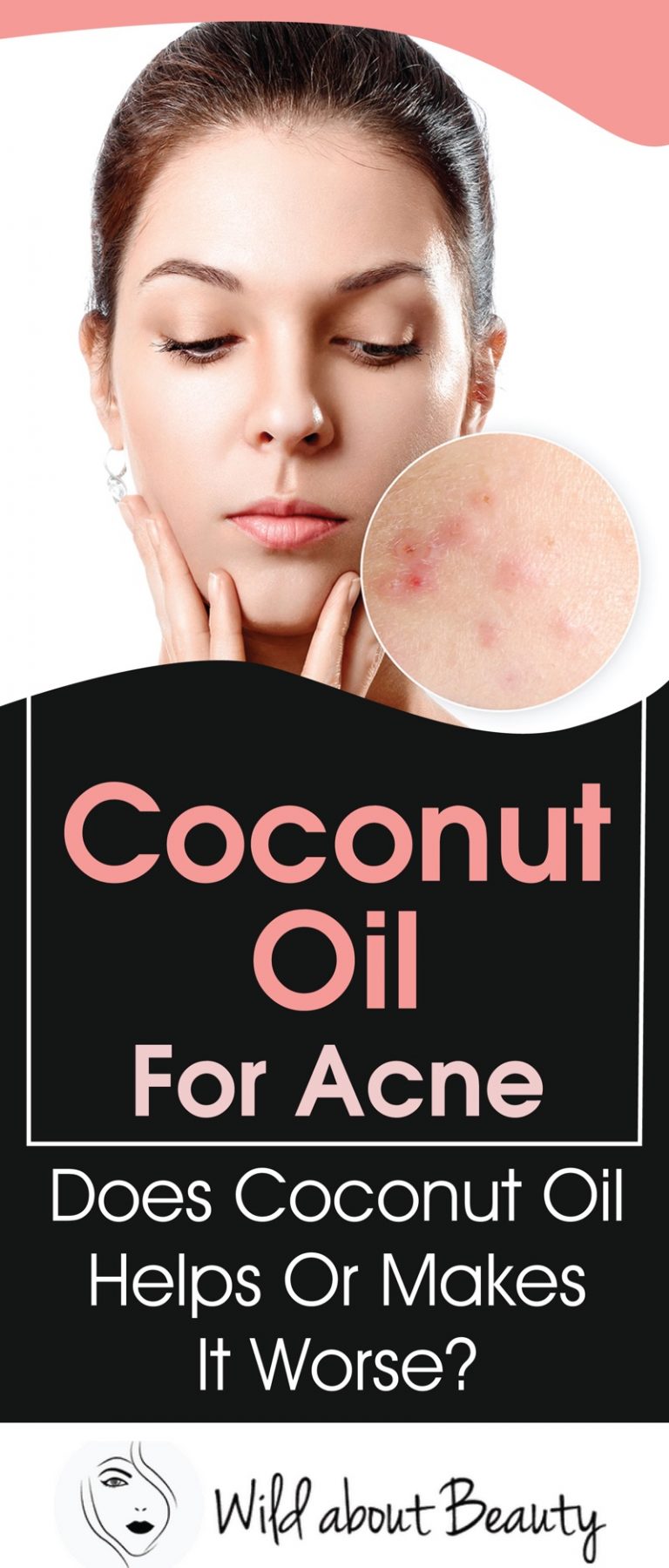 Coconut Oil for Acne Does Coconut Oil Helps or Makes It Worse?