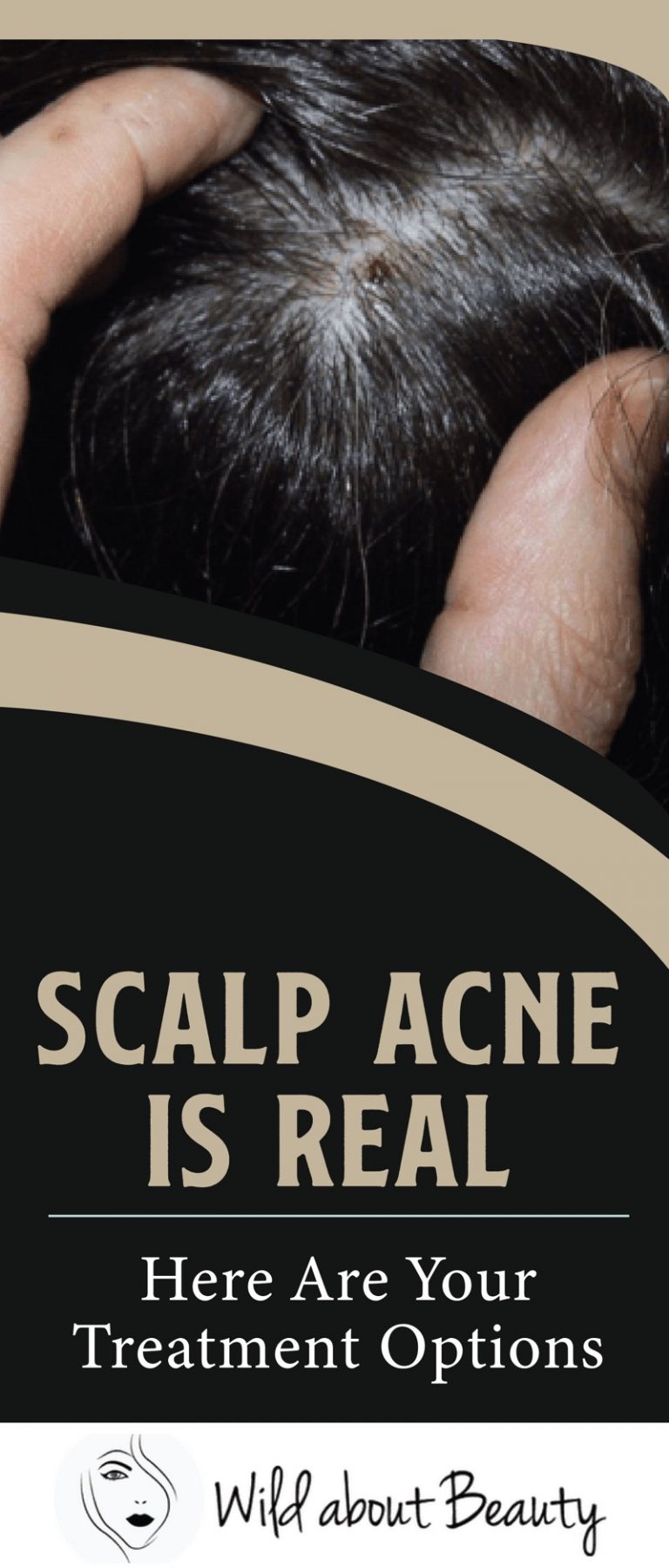 Scalp Acne Is Real Here Are Your Treatment Options