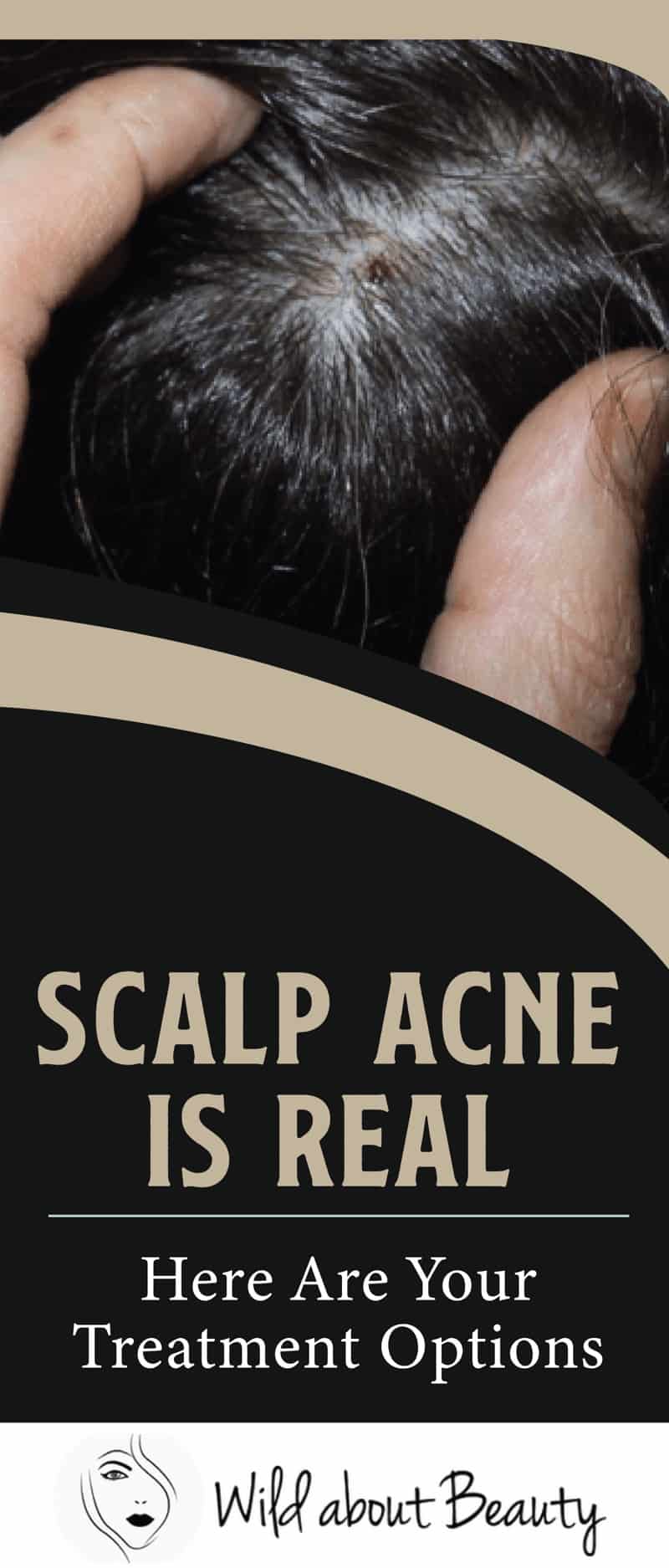 Scalp Acne Is Real