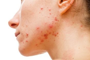 Acne scabs
