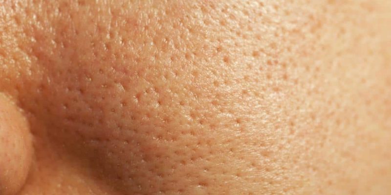 Is it Possible to Shrink Large Pores? Of Course it is - Wild About Beauty