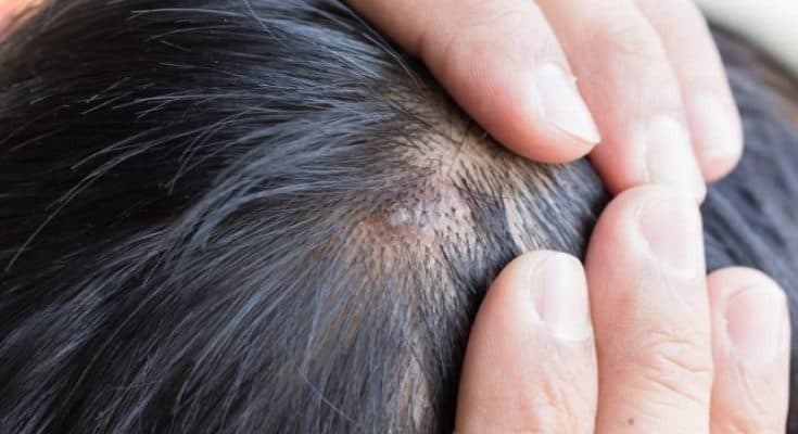 Dark Spots On Scalp Hair Loss