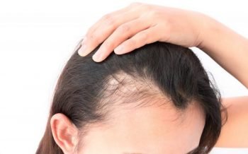 Women with hair loss