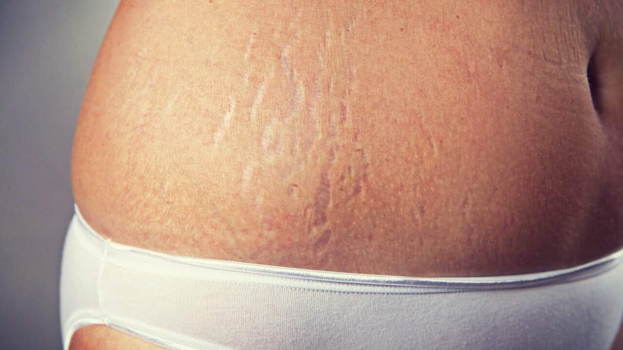 stretch-marks-after-pregnancy-how-to-get-rid-of-them