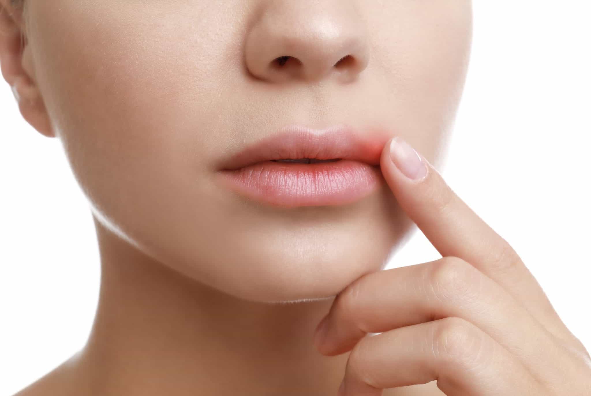 5 Tips For Preventing Cold Sores