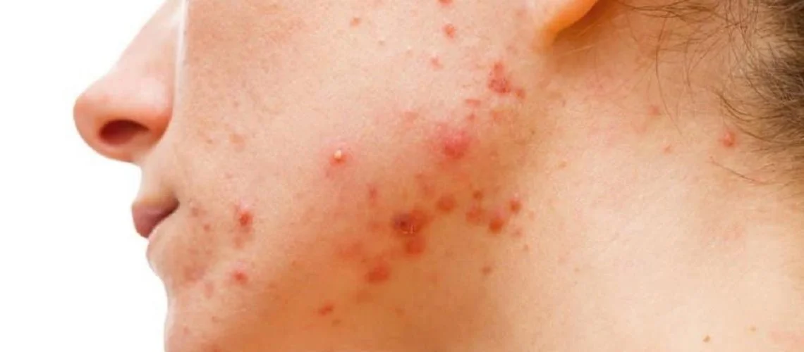 Acne scabs
