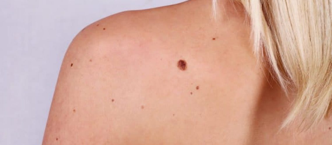 woman with skin tags